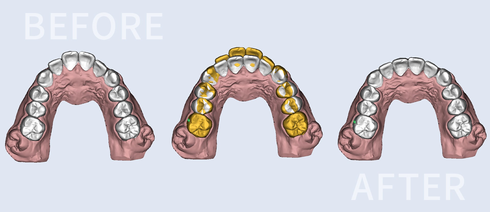 マウスピースによる歯科矯正、矯正前と矯正後