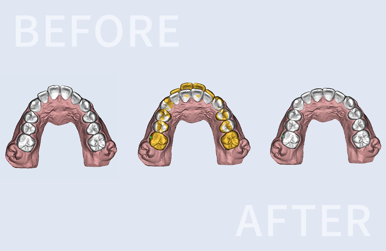 マウスピースによる歯科矯正、矯正前と矯正後