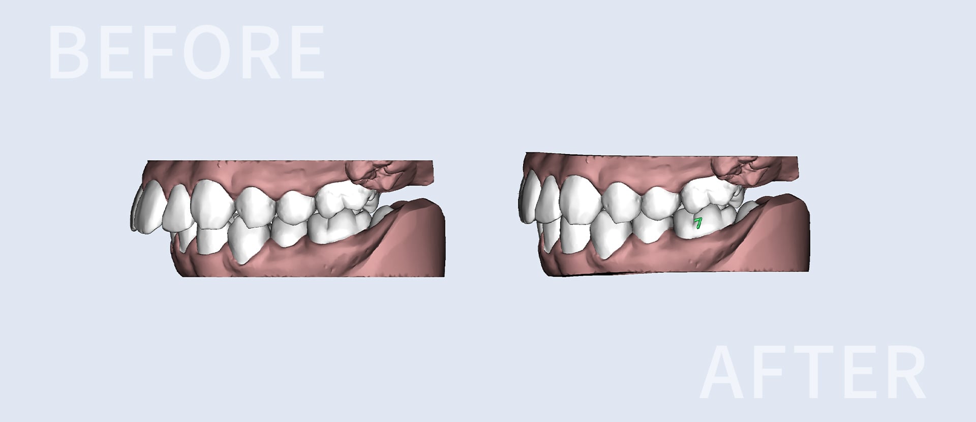 マウスピースによる歯科矯正、矯正前と矯正後
