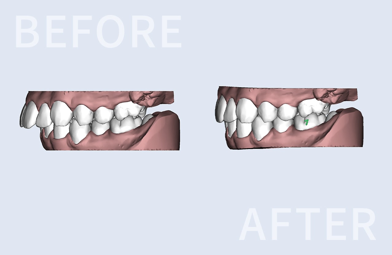 マウスピースによる歯科矯正、矯正前と矯正後