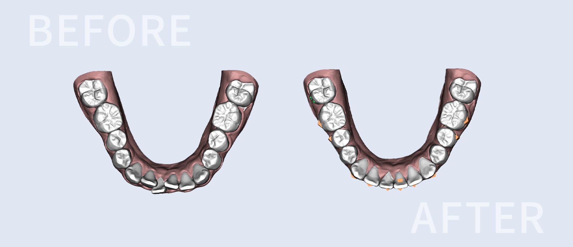 マウスピースによる歯科矯正、矯正前と矯正後