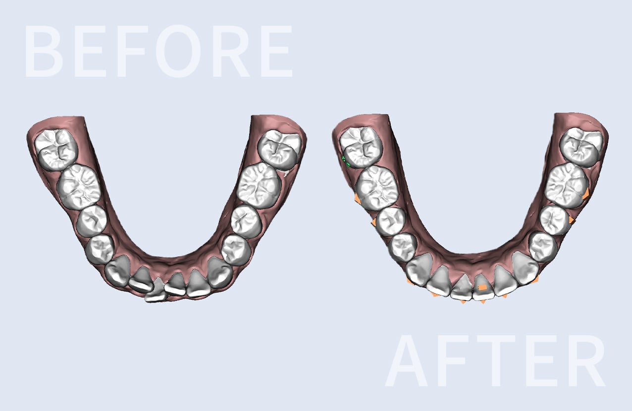 マウスピースによる歯科矯正、矯正前と矯正後